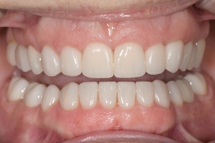 Dental Clinic Oakville Full-Mouth Rehabilitation after picture