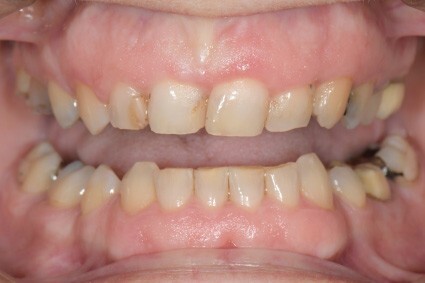 Dental Clinic Oakville Full-Mouth Rehabilitation before picture