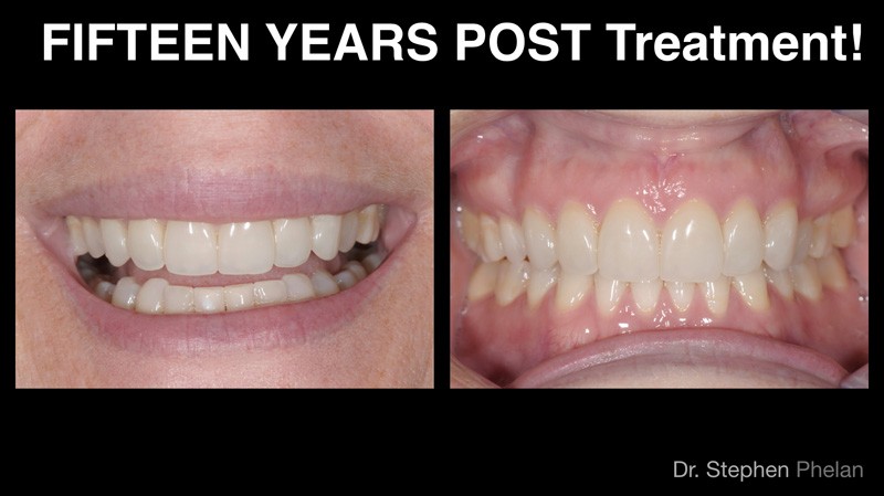 Before and After Veneer Treatment