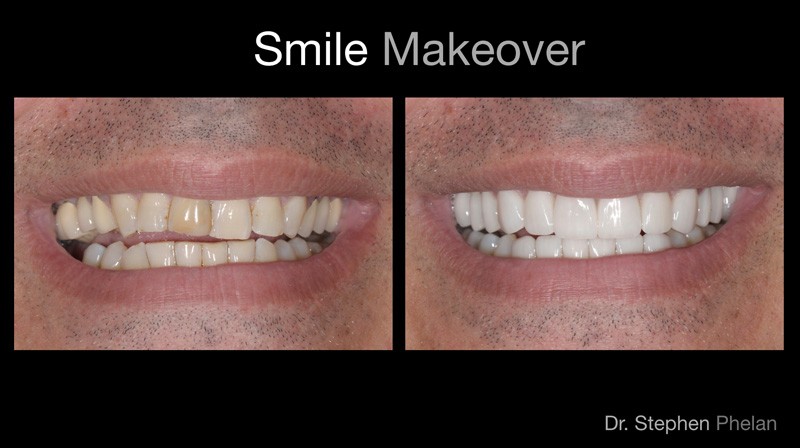 Before and After Porcelain Restorations