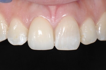 Dental Clinic Oakville Implants after Treatment