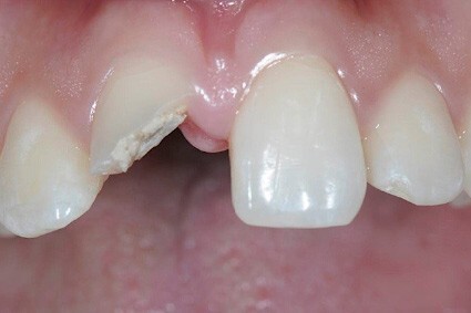 Dental Clinic Oakville Implants before Treatment